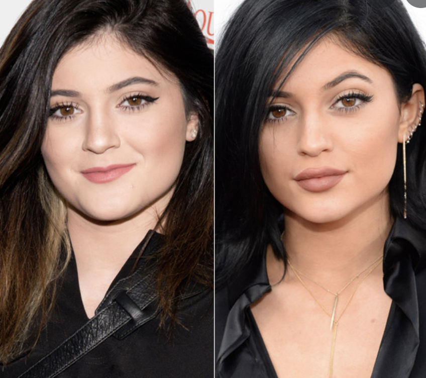 Kylie Jenner antes y después de inyectarse lip fillers