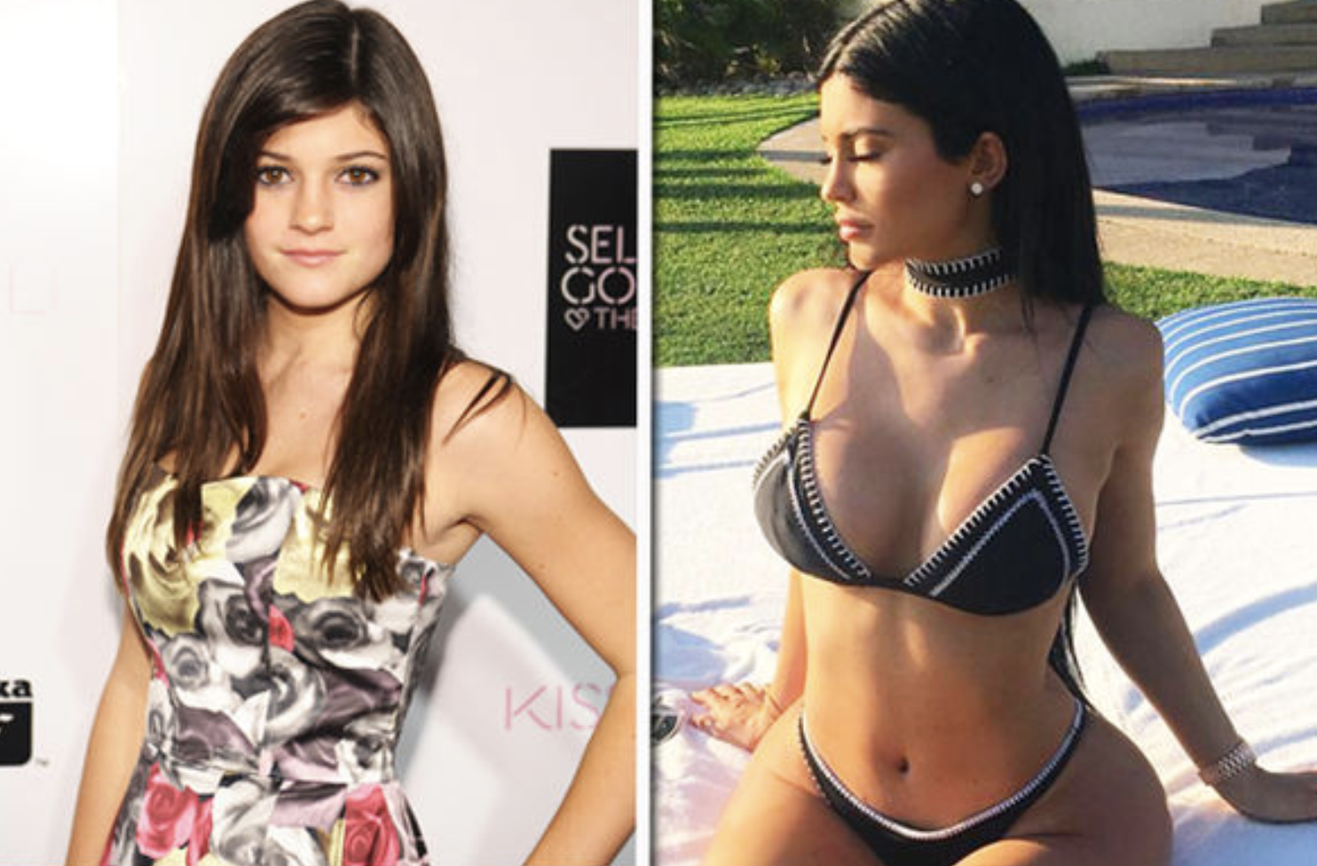 Kylie Jenner antes y después de hacerse cirugía