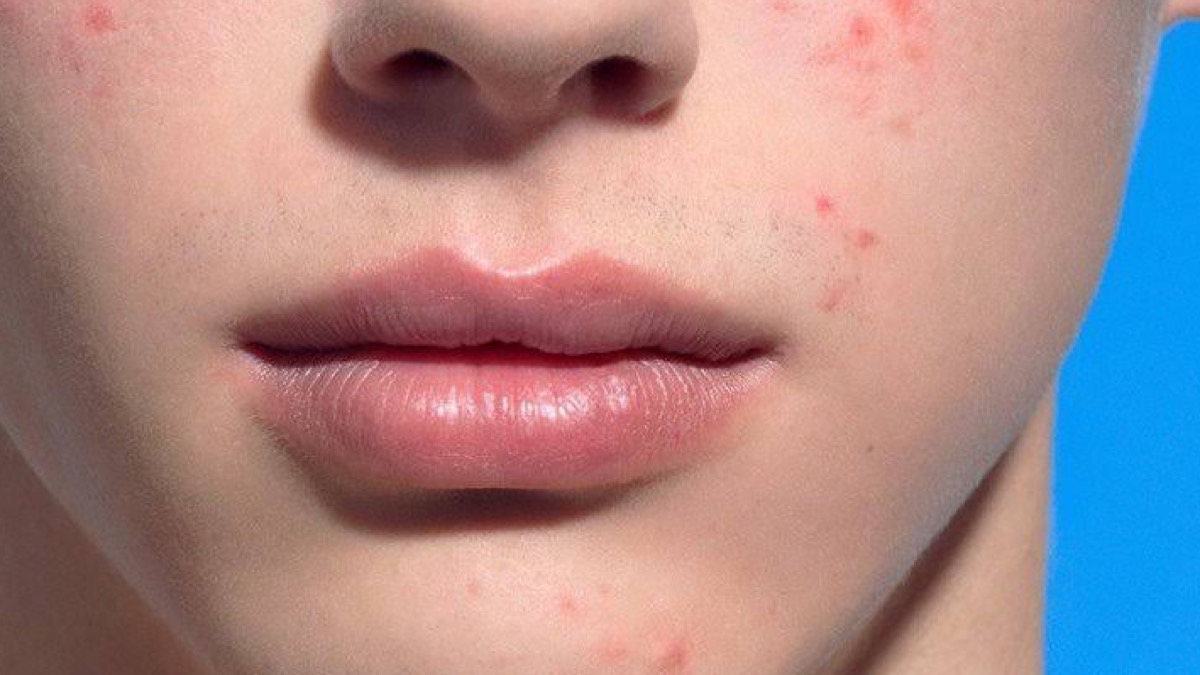 Acné hormonal: el problema del que nadie habla
