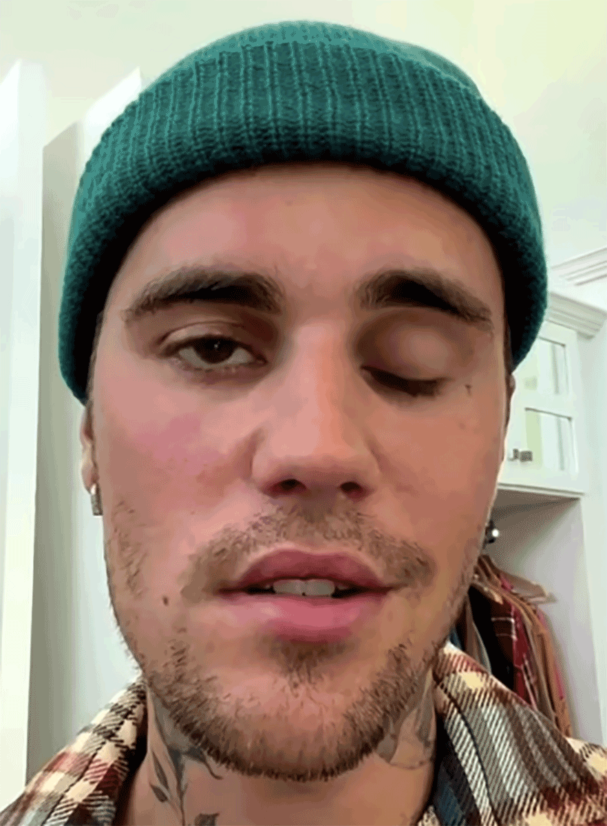 Justin Bieber cuando anunció que fue diagnosticado con el síndrome de Ramsay Hunt.