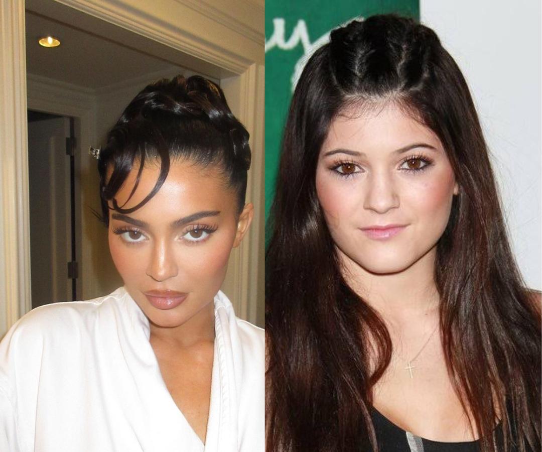 Kylie Jenner antes y después de cirugía de nariz.