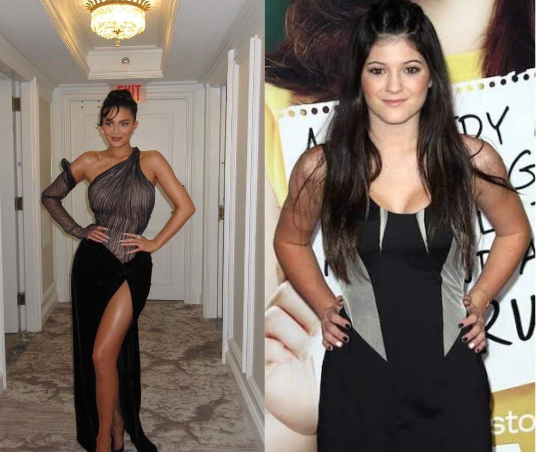 Kylie Jenner antes y después de cirugías estéticas.