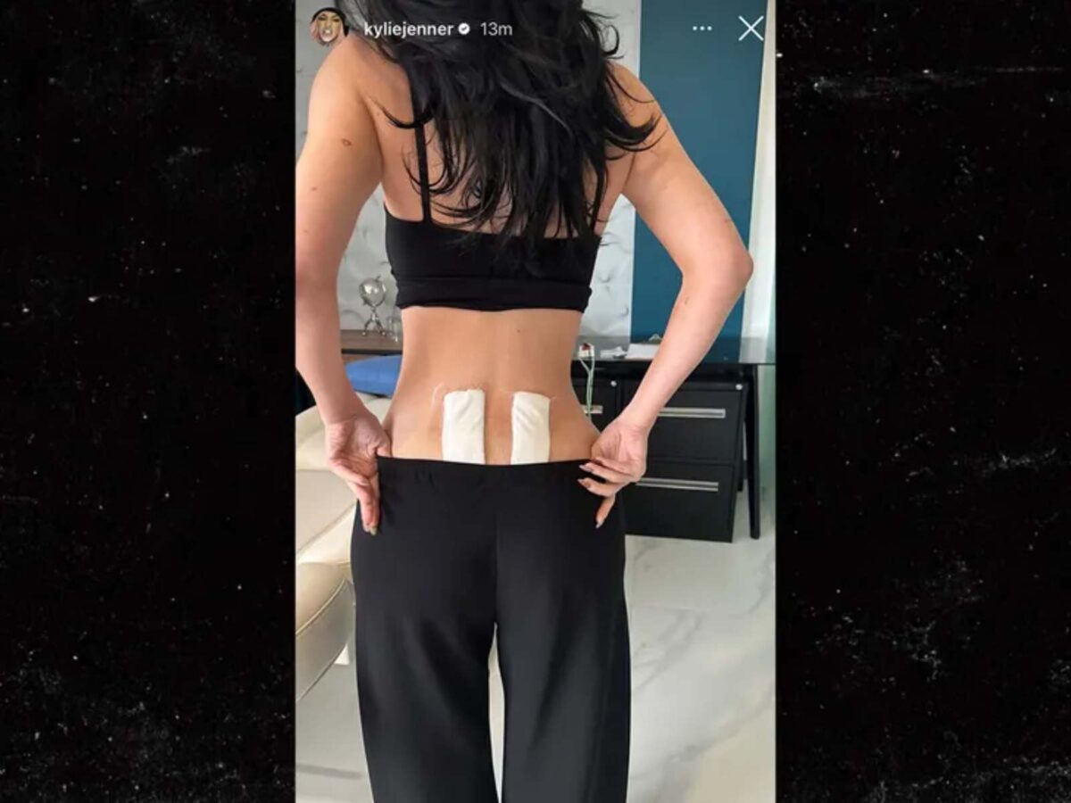 Kylie Jenner mostró el tratamiento al que se sometió.