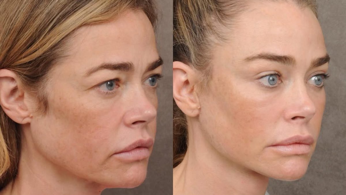 Denise Richards apuesta por la cirugía estética para renovar su imagen en medio de su divorcio con Aaron Phypers