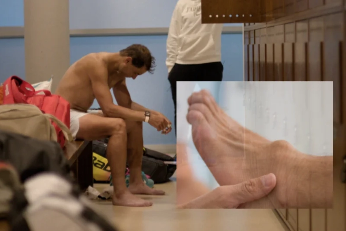 Rafael Nadal muestra por primera vez cómo se encuentra su pie por el síndrome Müller-Weiss.